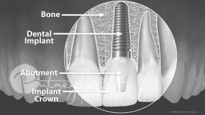 dental implant