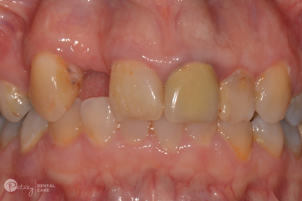 Cracked Tooth Syndrome Symptoms and Causes | Putney Dental Care