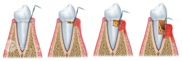 Treatment of Gum Infections- Putney Dental Care