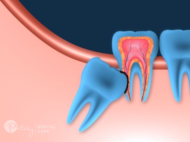 Wisdom Teeth Removal: Dentist in Ryde, Gladesville and Meadowbank