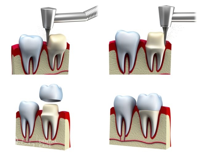 Crown Procedure 