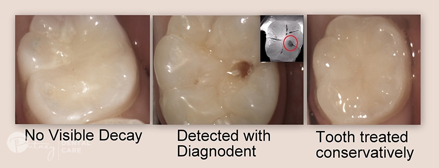 Reliable detection with Diagnodent