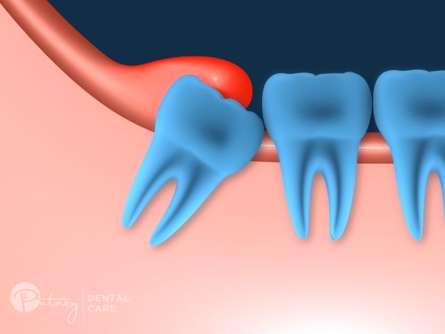 Emergency Dental Care