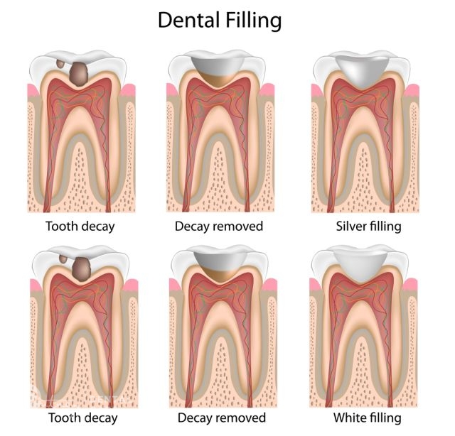 The image shows the Patient the Process of Inserting a Dental Filling.