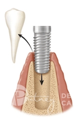 Extraction & Grafting