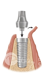 Insertion of the Abutment