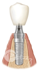 Attachment of Crown