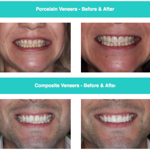 Porcelain Veneers Hunters Hill