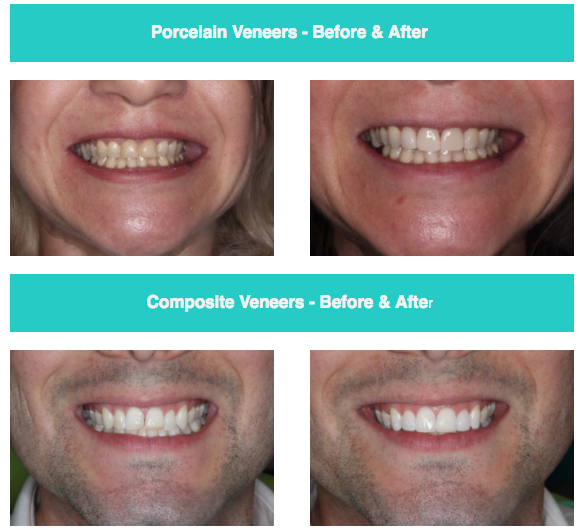 Porcelain Veneers Hunters Hill