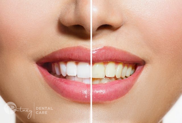 Teeth Whitening Meadowbank