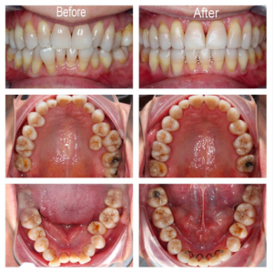 Braces Macquarie Park - Before and After
