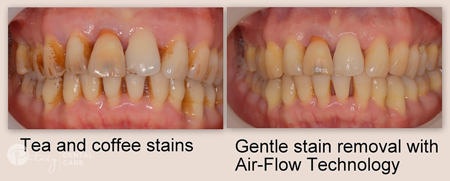 Modern Techniques of Air Flow Polishing