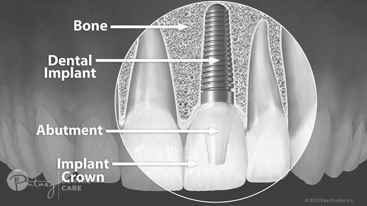 Dental Implants Ryde