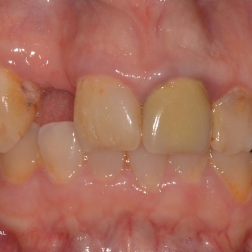 Wisdom Teeth Removal Procedure
