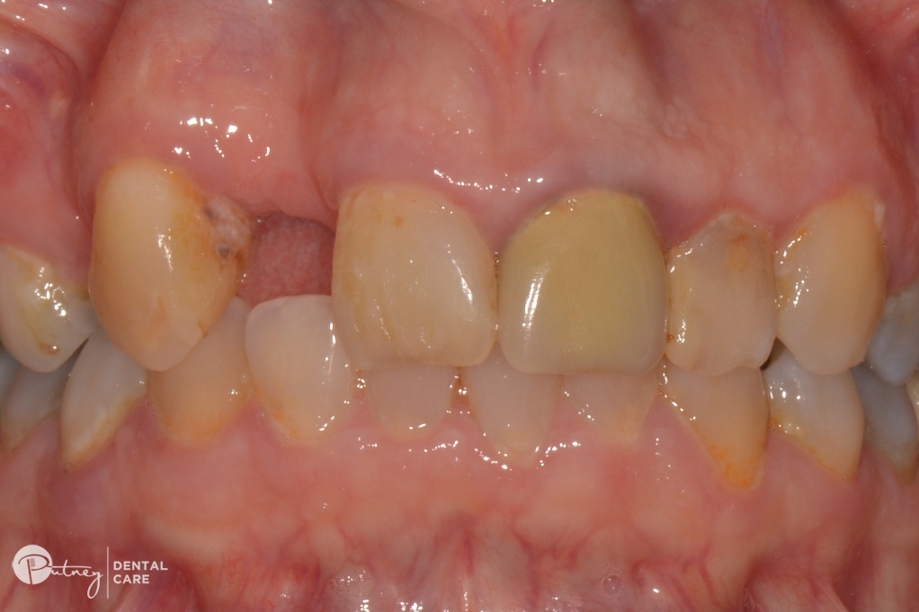 Wisdom Teeth Removal Procedure