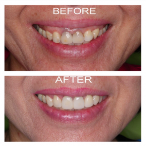 Porcelain Veneers Macquarie Park - Before and After