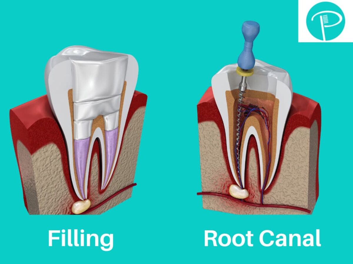 Step by Step Dental Filling Procedure