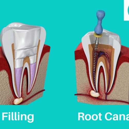 Cover photo for Filling vs Root Canal blog post.