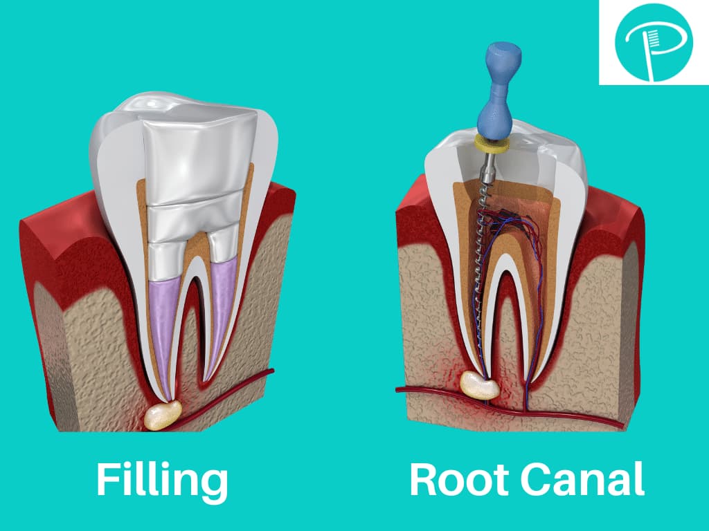 Root canal