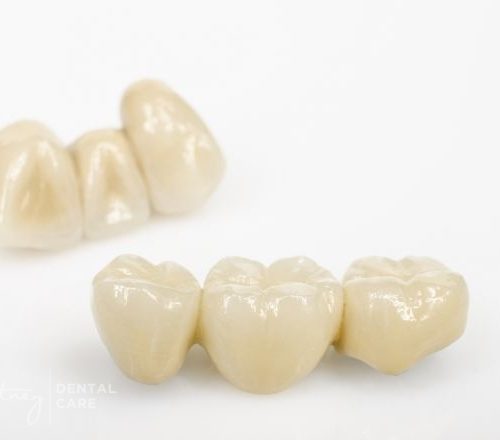 Crowns & Bridges - Putney Dental Care