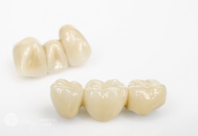 Crowns & Bridges - Putney Dental Care