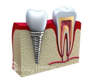Dental Implants Illustration