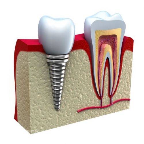 Recovering from Dental Implants