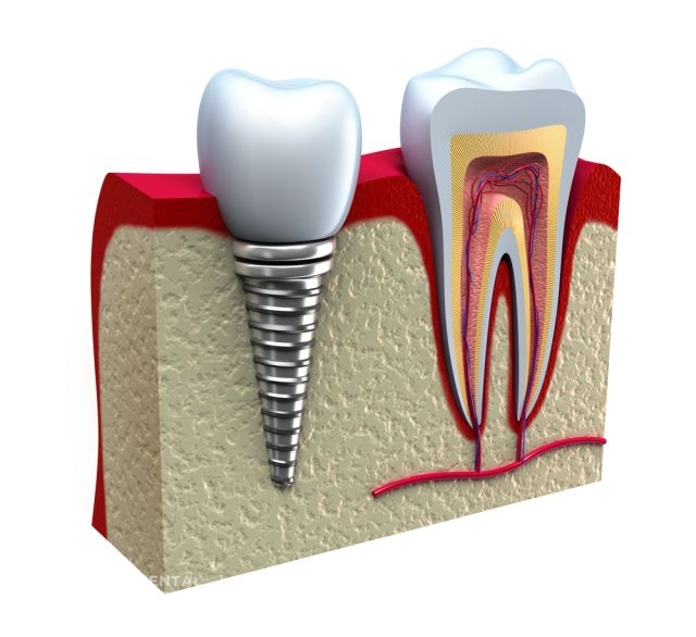 Recovering from Dental Implants