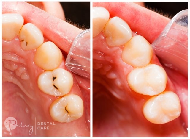 Image Shows What Dental Fillings Looks Like for a Patient.