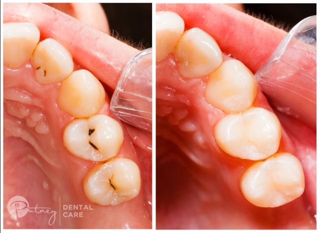dental fillings dental fillings