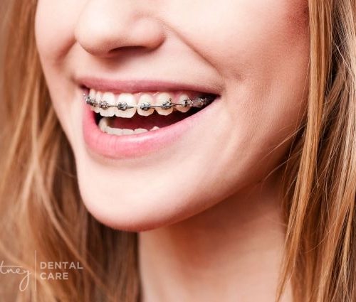 Braces Macquarie Park