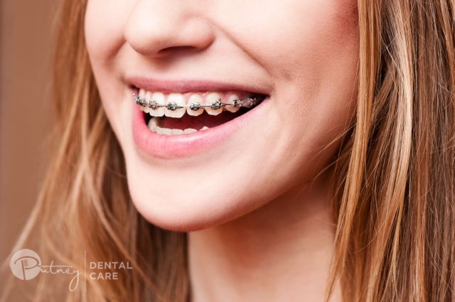 Braces Macquarie Park