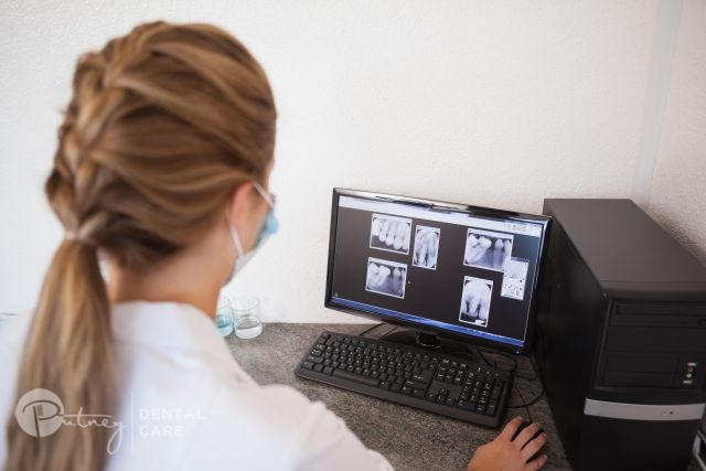 Appointment: Dental Veneer Placement
