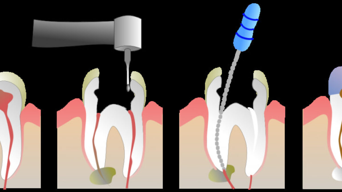 6 Signs of Infection After Root Canal - Putney Dental Care