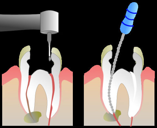 Root Canal