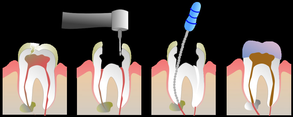 Root Canal
