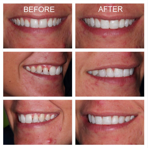 Before and after composite veneers. 