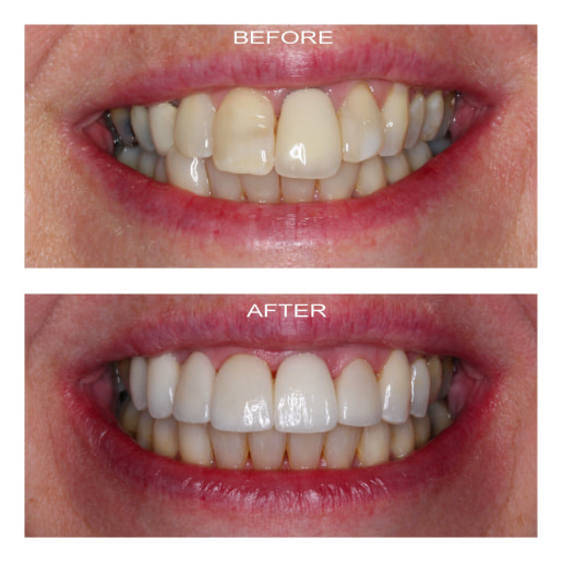 Orthodontics and Veneers Before and After at Putney Dental Care