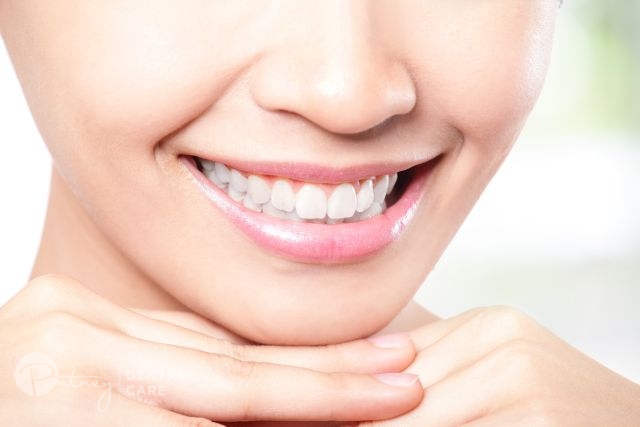 Teeth Whitening Hunters Hill - Putney Dental Care