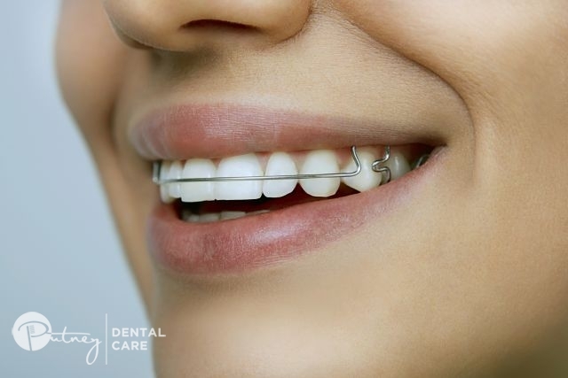 Dental Floss Braces
