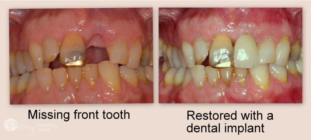 Dental Implants Hunters Hill