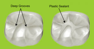 dental-sealant