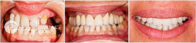 Dental Veneers - cosmetic dentistry