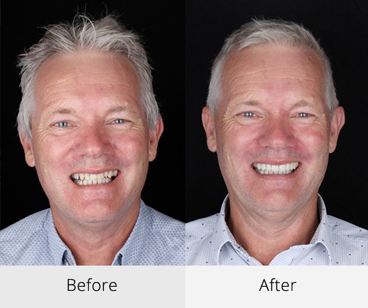 Teeth Whitening Ryde - Before & After