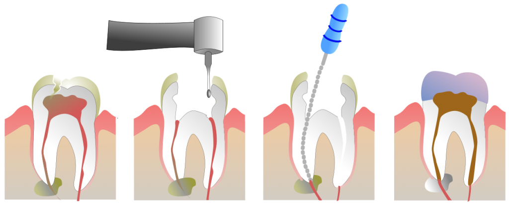 Root Canal Treatment Procedure