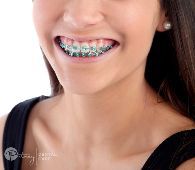 Braces