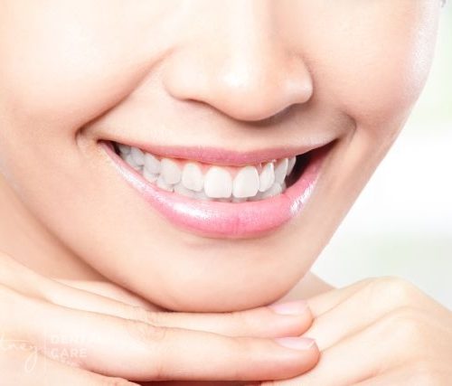 Teeth Whitening Hunters Hill