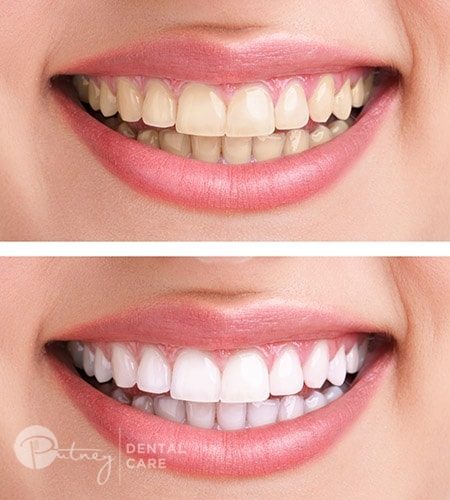 Teeth Whitening Hunters Hill